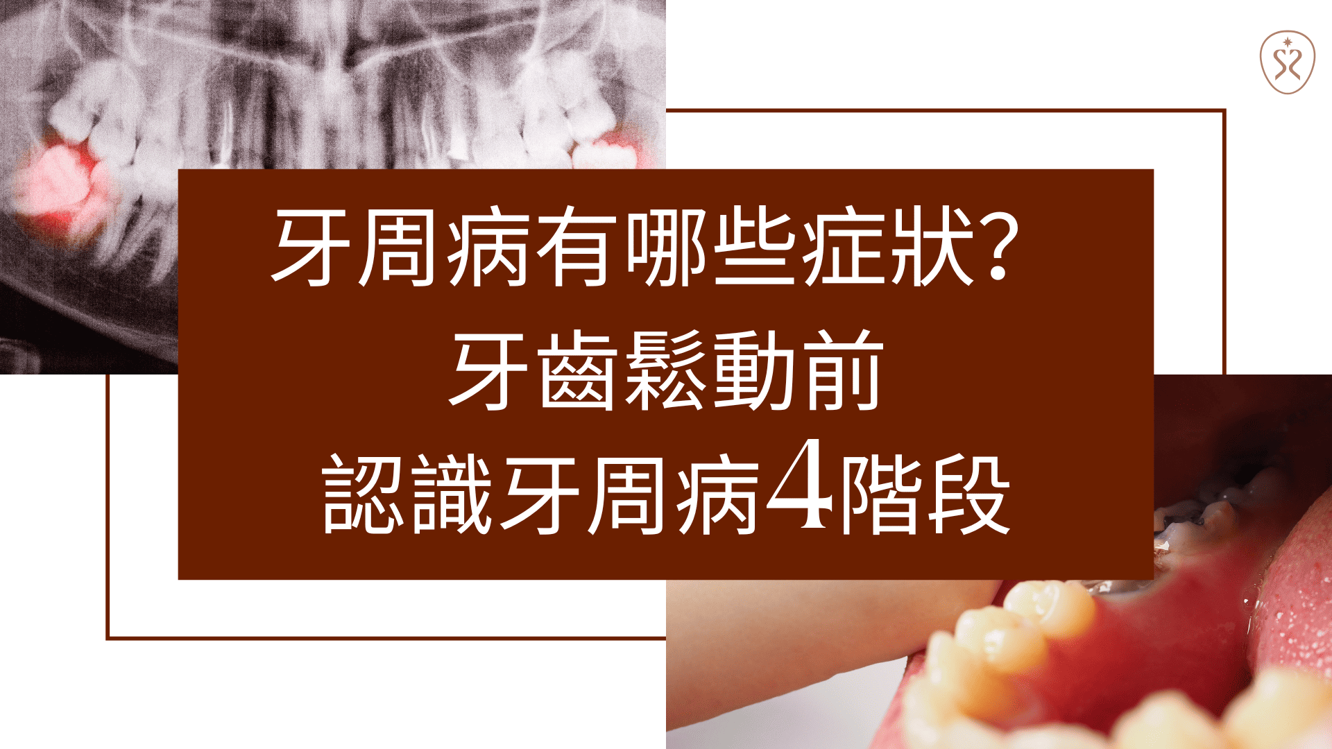牙周病有哪些症狀？ 牙齒鬆動前，認識牙周病4階段